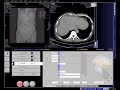 how to make ct scan of whole abdomen siemens in syngo acquisition workplace..