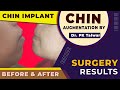 Chin Implant Surgery, Results Before After, Chin Augmentation By Dr. PK Talwar in Delhi