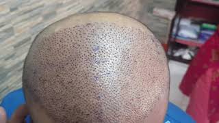 3000 grafts front coverage done by FUE by Dr.Sreenath at Hair O Dent clinic