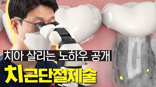 치아 살리는 노하우 공개 치근단절제술