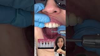 How Do Dentists Create Gap between Teeth and Why ?!