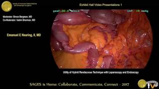 Utility of hybrid Rendezvous technique with laparoscopy \u0026 endoscopy