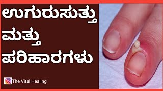 Nail wrap /uguru suttu remedies