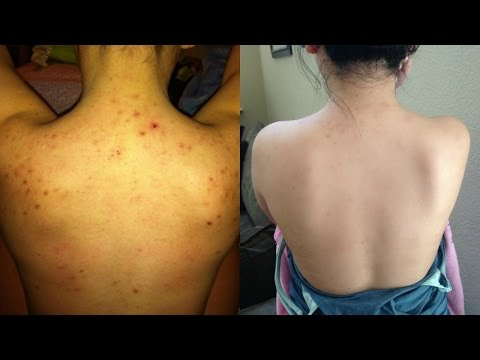 How I Cleared My BACNE! + Easy and Afforadable DIY Masks How I Cleared My BACNE! + Easy and Afforadable DIY Masks