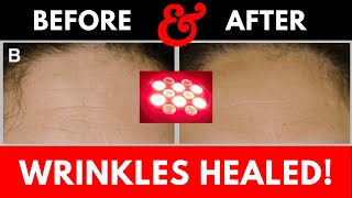 Red Light Therapy Wrinkle Treatment Before and After