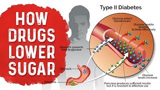 Diabetes Medication Side Effects: Metformin, Sulfonylurea & Insulin – Dr.Berg