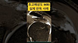 어깨 회전근개파열 초고해상도 3T MRI 실제 판독 사례