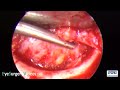 orbital trapdoor fracture repair with porous ethylene coated titanium implant