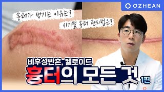 켈로이드? 비후성반흔? 흉터에 대한 모든 것을 알려드립니다!