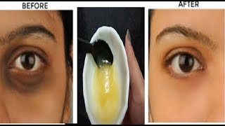 रोजाना बस 1 मिनट इससे मसाज करलो UNDER EYE DARK CIRCLES \u0026 झुर्रिया हमेशा के लिए दूर होगे #DARKCIRCLES