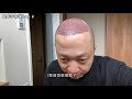 🔥終於做了！植髮手術！｜植飛日本全記錄【1】2500 grafts hair transplant norwood 7 day 0 to 7