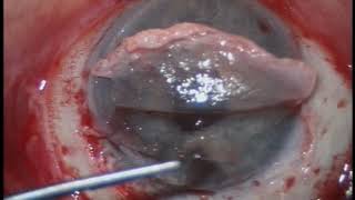 Artificial Corneal Transplant in Extremely complex Eyes - Surgical Film Competition Award