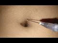 navel injection