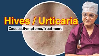 Hives/Urticaria Explained:  Causes, Symptoms, and Treatments -  Skin Rash | Allergy Dr. naren pandey