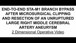 Bypass for MCA Aneurysm