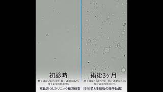 恵比寿つじクリニック精液検査   手術前と手術後の精子動画 [6]