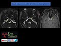 Sixth 6 th  cranial nerve anatomy and radiological approach