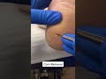 Satisfying painful hard corn removal by australian podiatrist