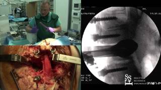 Vertebral Column Resection Demonstration by Jens Chapman, M.D.