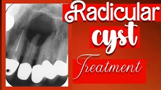 radicular cyst treatment Endodontics procedure#dentist #satisfying #dentistry #rootcanal#crown