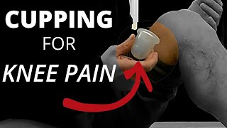 Cupping for Knee Pain | Cupping After A Total Knee Replacement