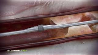 Coronary Orbital Atherectomy