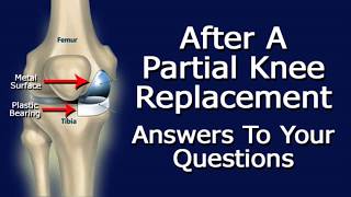 After Partial Knee Replacement Surgery:  Answers To Your Questions