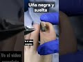 uña negra desprendida podologia uñanegra nails nailsgrowth uñaslargas uñas podologo