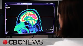 Alzheimer's drug hailed as breakthrough, but may have side effects