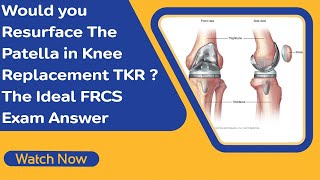 Would you Resurface The Patella in Knee Replacement TKR ? The Ideal FRCS Exam Answer