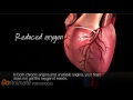 An Overview of Angina