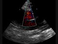 Echocardiogram In Perimembranous Ventricular Septal Defect