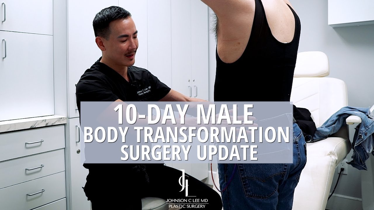 10-Day Update Male Body Transformation 360 Lipo + BBL | Dr. Johnson C ...