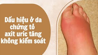 Dấu hiệu ở da chứng tỏ axit uric tăng không kiểm soát | Báo Lao Động