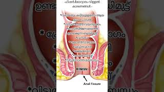 ഫിഷർ /മലാശയ വിള്ളൽ വരുന്നതിനുള്ള കാരണങ്ങൾ