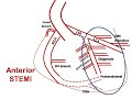 ECG course: Culprit in Anterior STEMI, Dr. Sherif Altoukhy