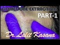 COMEDONE EXTRACTIN by Dr.Lalit Kasana PART-1