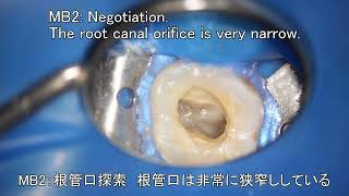 393.熊谷市鴻巣市マイクロスコープ根管治療　坂詰歯科医院　2023年日本顕微鏡歯科学会春大会で使用した症例動画１