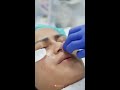 NOVI'S Dermatology Clinic - Tanam Benang Hidung ( Nose thread lift )