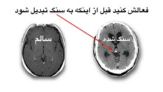 فراماسونری و چشم مشیت ویدیوی کامل - آیا غده صنوبری شما (چشم سوم) تبدیل به سنگ شده؟ روش فعال کردن آن