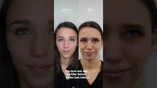 Eye Brow & Jaw line Filler Before and After Look🤓#shorts @Glam Rose