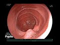 endoscopia hfi sbad enteroscopia duplo balão