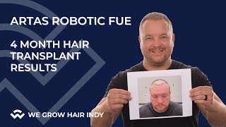 ARTAS Robotic FUE Hair Transplant 4 Months Later - Josh S.