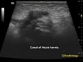 Ultrasound showing hernia of canal of Nuck (inguinal hernia) in 25 days old girl.