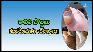 Best Tips To Cure Burnt Injuries | కాలిన బొబ్బలు మానేందుకు చిట్కాలు | Health Updates | Janatha Tube