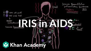 Immune reconstitution inflammatory syndrome (IRIS) in AIDS | NCLEX-RN | Khan Academy