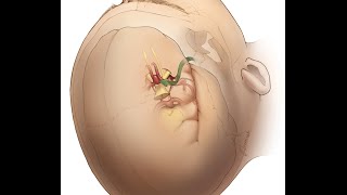 Anterior Communicating Artery Aneurysms (Preview)