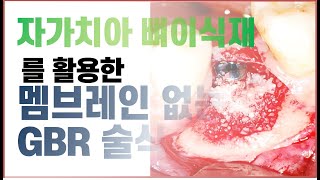 [한국치아은행] #1. 멤브레인 없이 GBR 술식이 가능한가요?