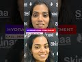 Hydra Facial Treatment | Viral #shorts