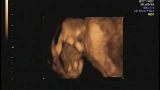 12w6d ultrasound- part 2